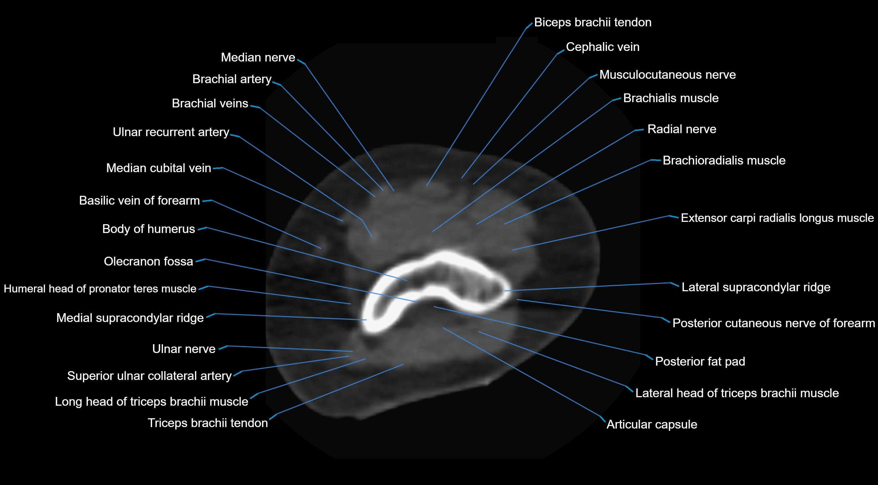CT elbow axial  cross sectional anatomy labelled  radiology image -00012.webp